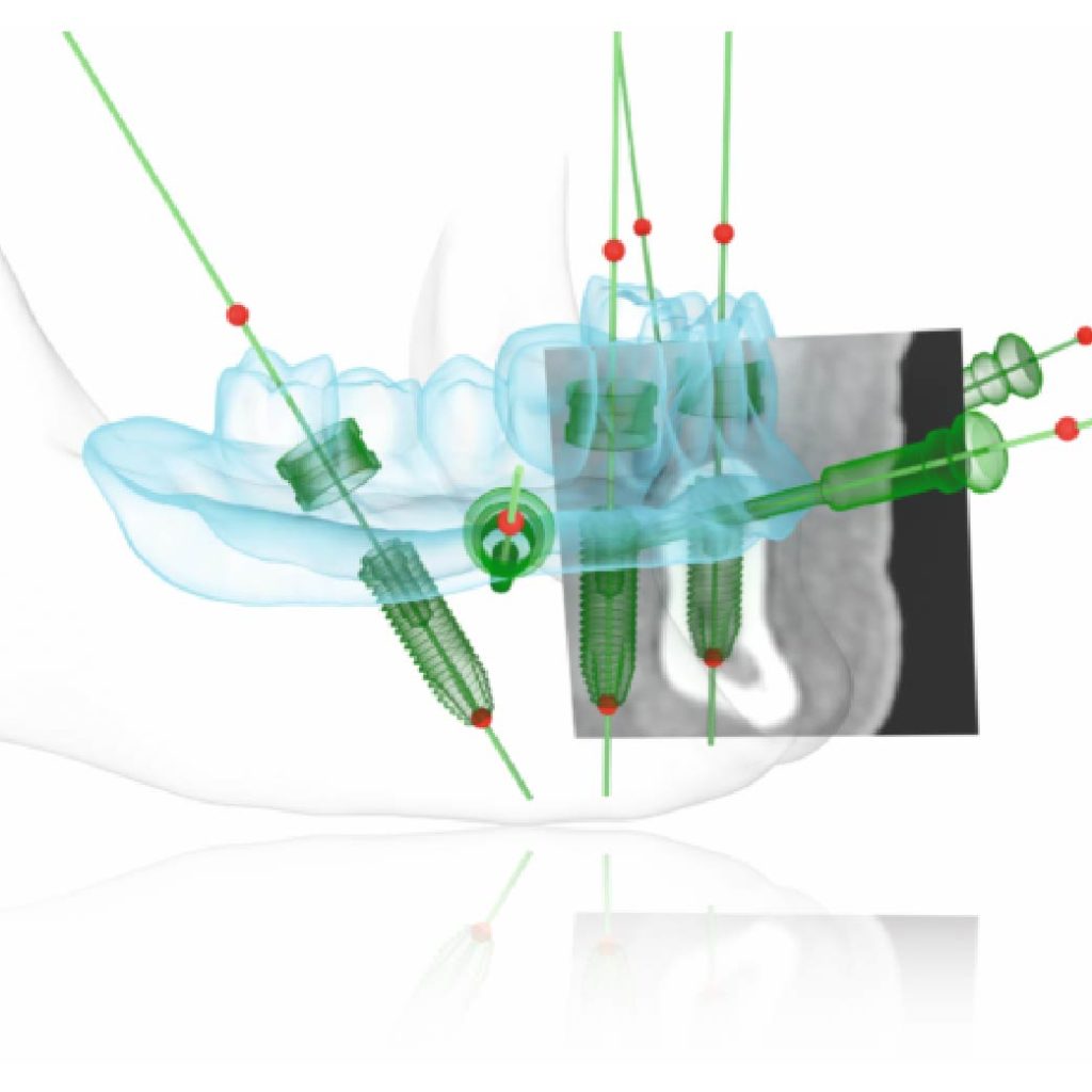 AO4手術醫師利用數位方式植入植體